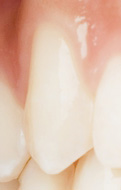 欧米人犬歯のイメージ